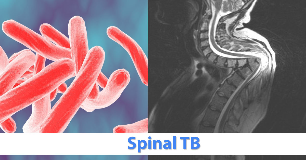 Early Diagnosis Of Spinal Tuberculosis